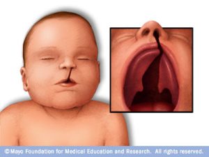 cleft_palate