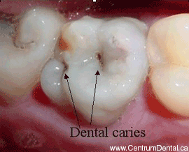 dental-caries